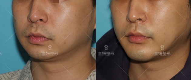 皇妍下巴手術-3D列印人工骨下巴手術