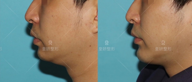 側面-皇妍下巴手術-3D列印人工骨下巴手術