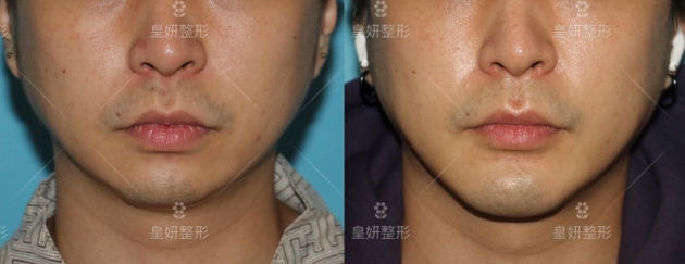 下巴手術-3D列印人工骨下巴手術